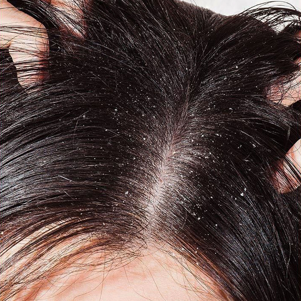 dandruff shampoo for men